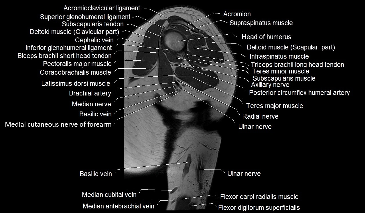 Upper arm (humerus ) saittal cross sectional anatomy 3T image 25.webp